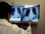 показатель заболеваемости туберкулезом в Уссурийске выше нормы